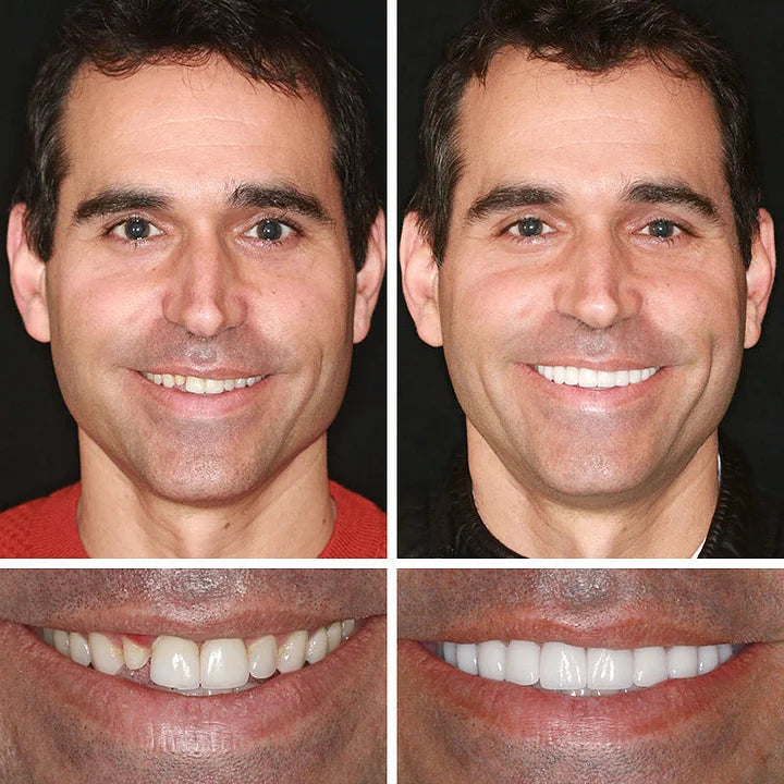 Ends Today ⏰ 70% OFF Exclusive Offer Pawoim™ Advanced Full Denture System 🦷 Pro-Level Suction Technology | Natural Aesthetic Fit | Daily Comfort Wear
