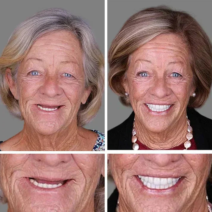 Ends Today: 70% OFF!  🏆2026 Bestselling Product🦷 Fit for a Fresh Smile, Say Goodbye to Wearing Discomfort!🌎