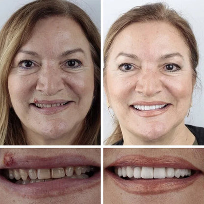 Ends Today ⏰ 70% OFF Exclusive Offer Pawoim™ Advanced Full Denture System 🦷 Pro-Level Suction Technology | Natural Aesthetic Fit | Daily Comfort Wear
