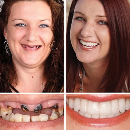 Ends Today: 70% OFF! ⏰DarkFairy™ Medical Full Denture with Strong Suctiond🦷