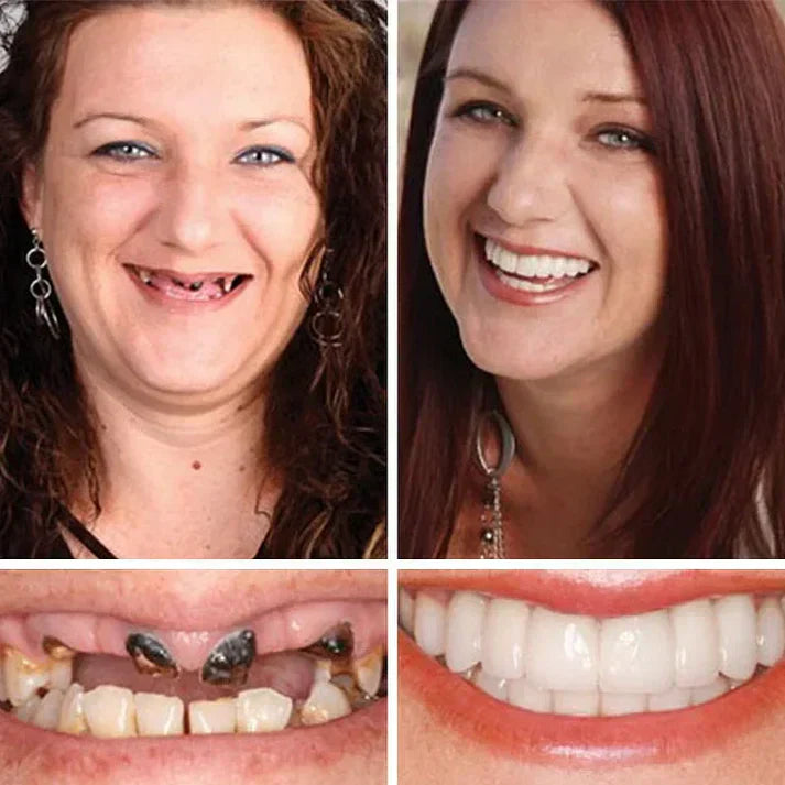 Ends Today: 70% OFF!  🏆2026 Bestselling Product🦷 Fit for a Fresh Smile, Say Goodbye to Wearing Discomfort!🌎