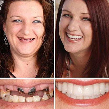 Ends Today: 70% OFF!  🏆2026 Bestselling Product🦷 Fit for a Fresh Smile, Say Goodbye to Wearing Discomfort!🌎